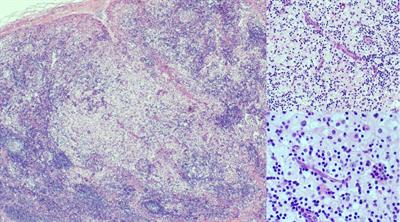 Case report: A new pathogenic variant of LRBA deficiency with a complex phenotype and Rosai-Dorfman disease